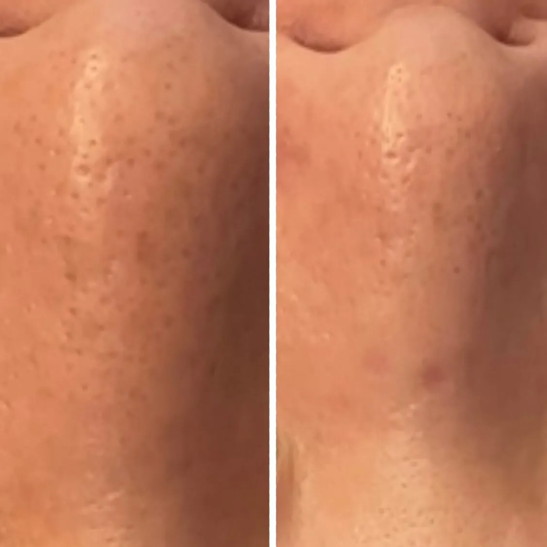 鼻の毛穴、あきらめていませんか⁉️